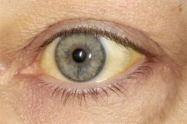 Žloutenka jen tak neustoupí, varují z kraje, kde už nemoc zabila pět lidí